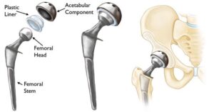 Best Hip Replacement Surgeon in Thane